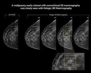 genius-3d-vs-2d-mammography