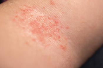 Rash on arm