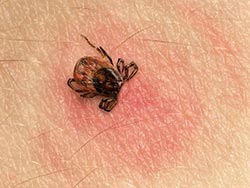 Tick bites