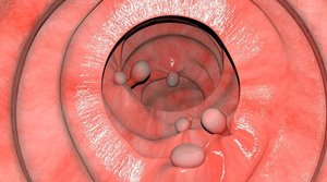 Colorectal polyps
